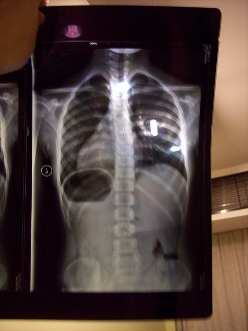 Hannah's spine - only 8 degree curve after 18 mo. of bracing!